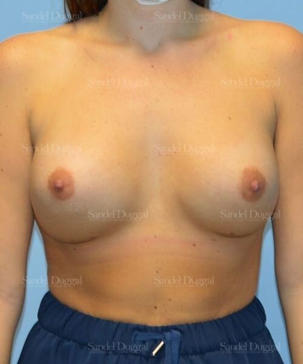 Breast Augmentation after, case 4756