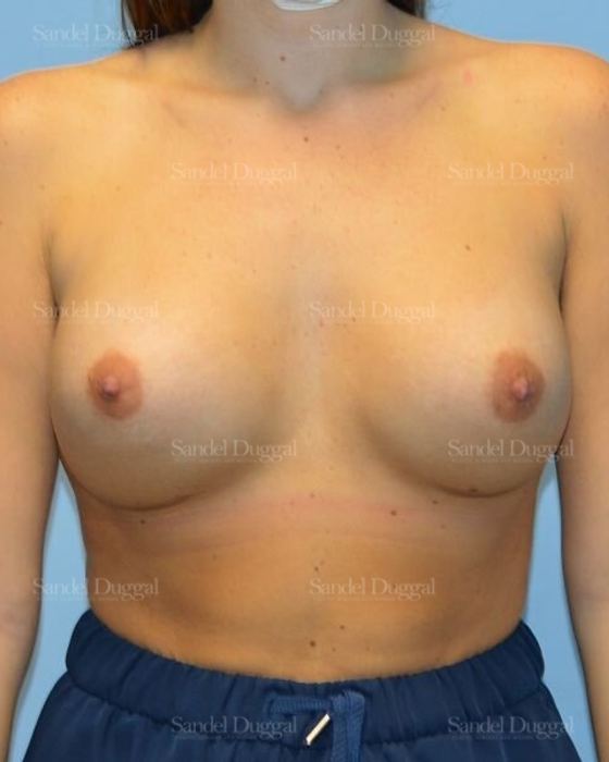 Breast Augmentation after, case 4756