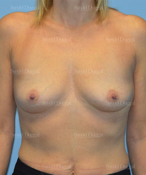 Breast Augmentation before, case 3262