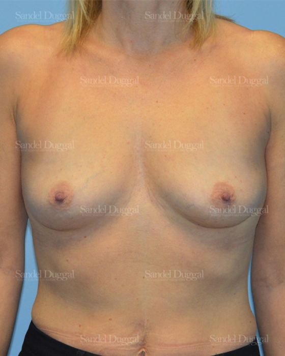 Breast Augmentation before, case 3262