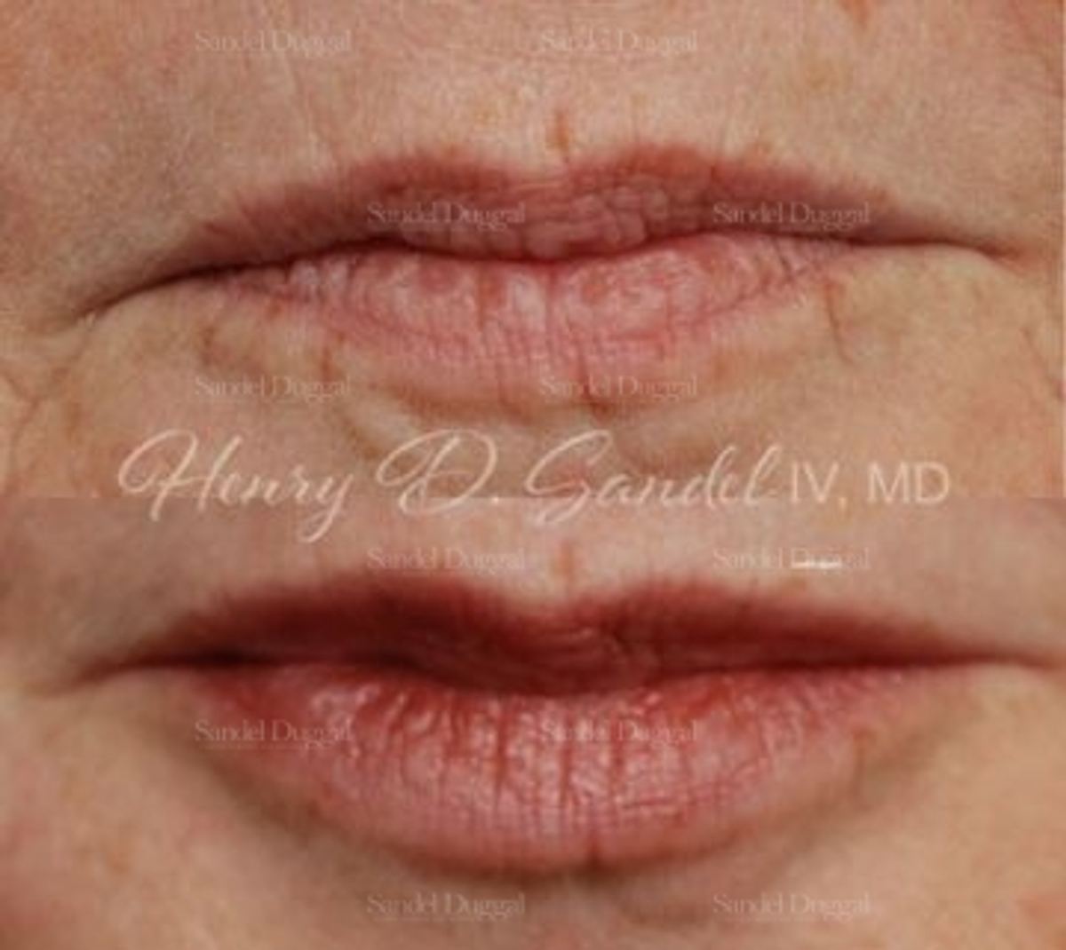 Lip Augmentation / Lip Lift before and after, case 4397