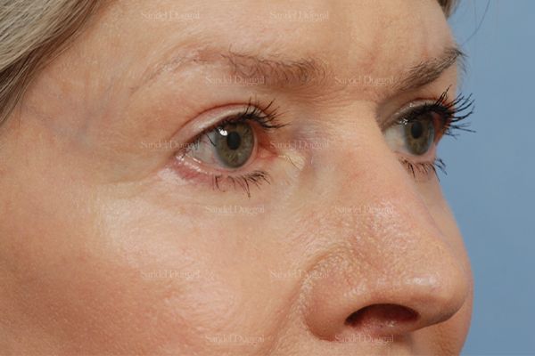 Eyelid Rejuvenation after, case 1912
