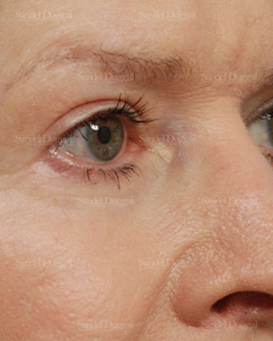 Eyelid Rejuvenation after, case 1912