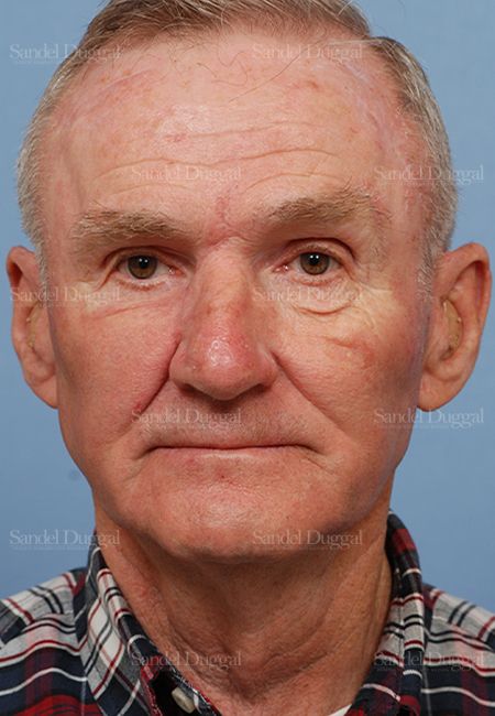 Reconstruction after Mohs after, case 2814