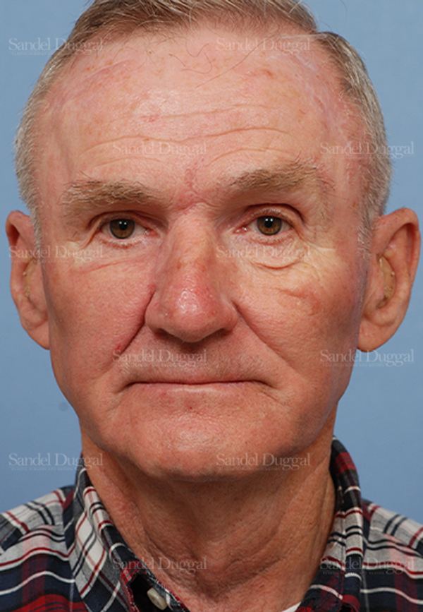 Reconstruction after Mohs after, case 2814