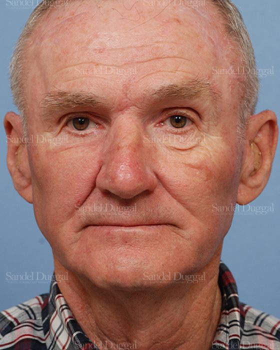 Reconstruction after Mohs after, case 2814