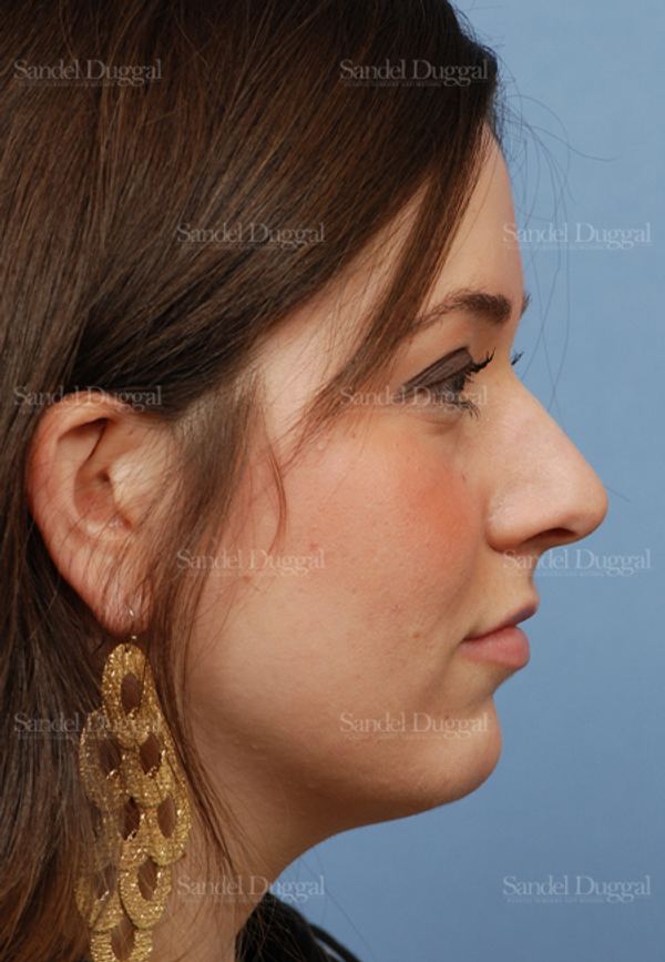 Rhinoplasty before, case 2894