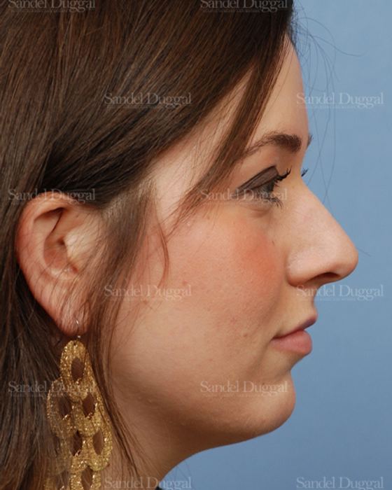 Rhinoplasty before, case 2894