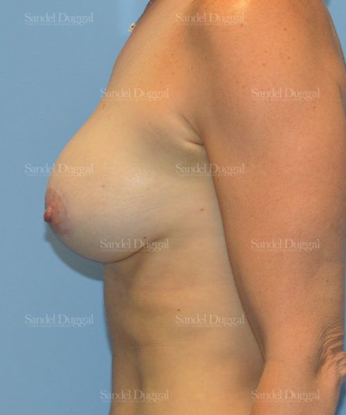 Breast Augmentation with Lift after, case 3393