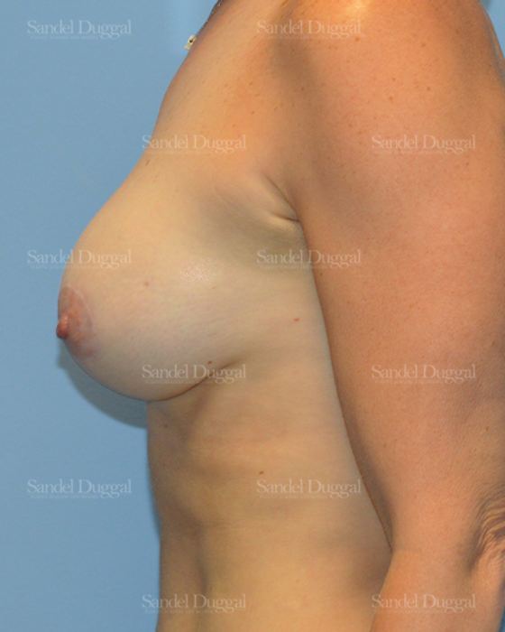 Breast Augmentation with Lift after, case 3393