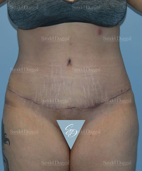 Tummy Tuck after, case 1701