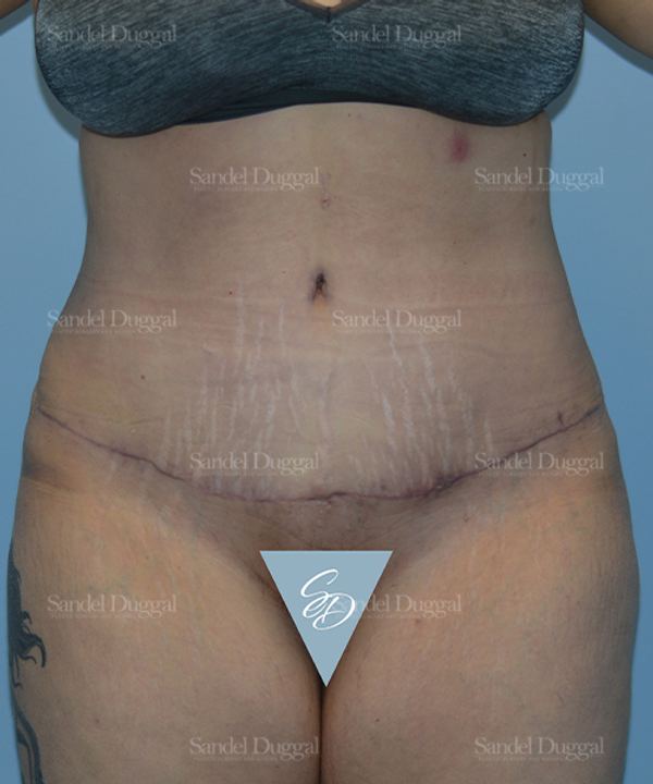 Tummy Tuck after, case 1701