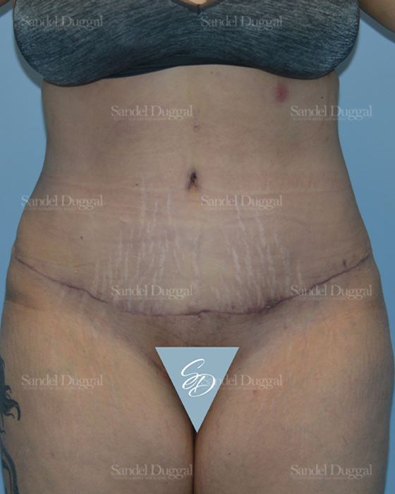 Tummy Tuck after, case 1701