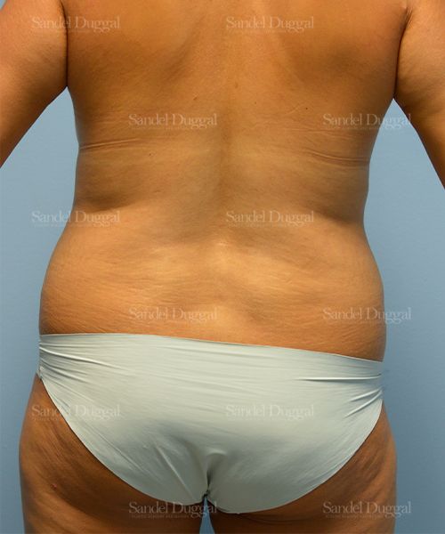 Liposuction — Legs & Flanks before, case 2520