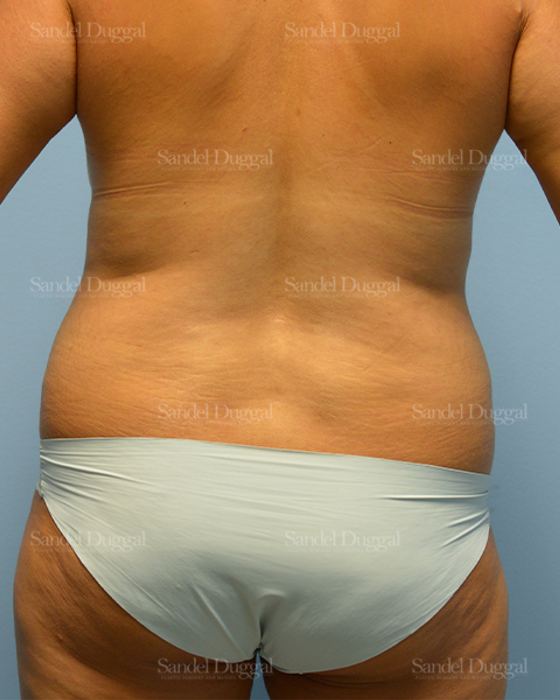 Liposuction — Legs & Flanks before, case 2520