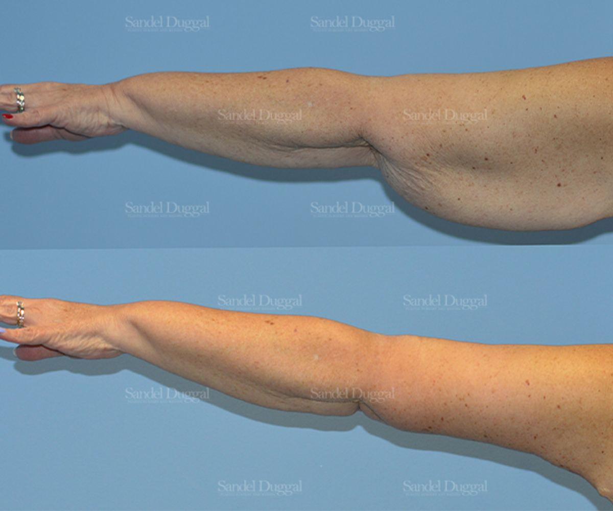 Brachioplasty before and after, case 2139