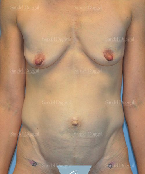 Tummy Tuck before, case 1622