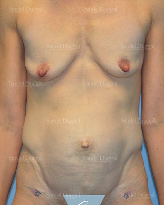 Tummy Tuck before, case 1622