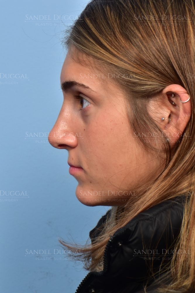 Rhinoplasty after, case 6003