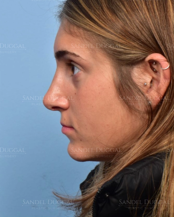 Rhinoplasty after, case 6003