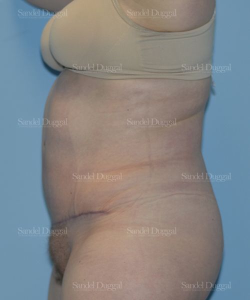 Tummy Tuck after, case 1666