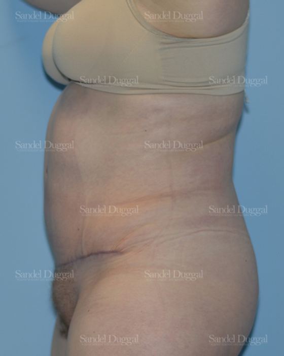 Tummy Tuck after, case 1666