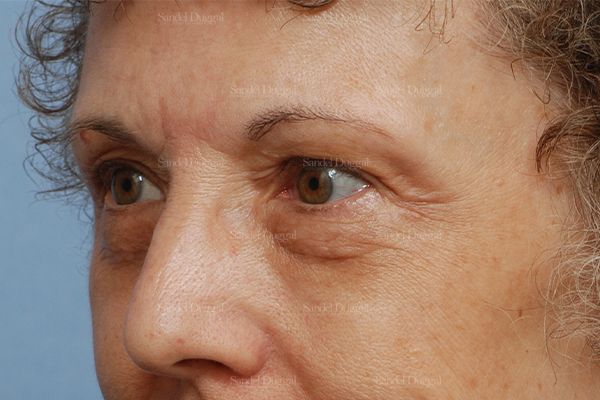 Eyelid Rejuvenation before, case 1907