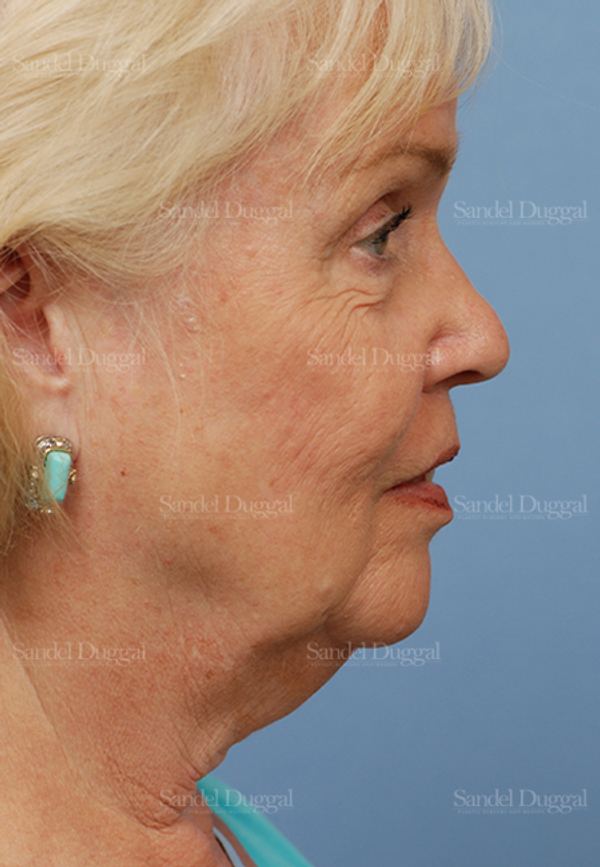 Facelift before, case 2680