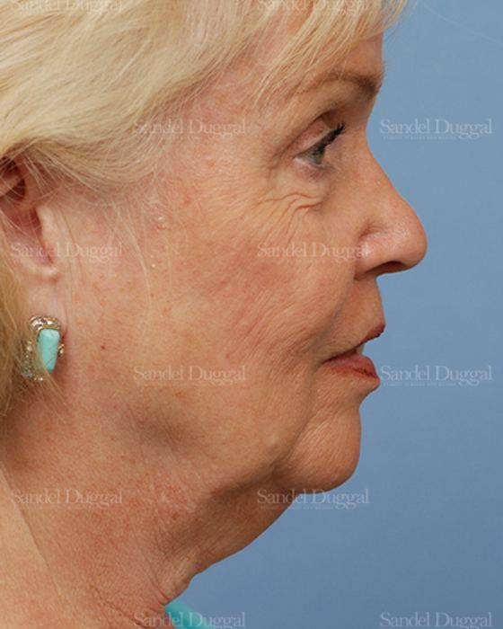 Facelift before, case 2680