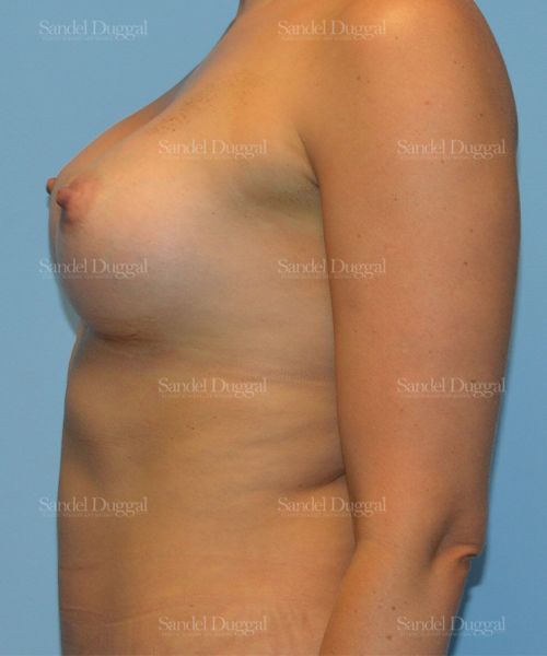 Breast Augmentation after, case 3122