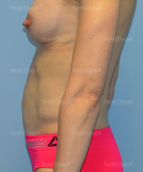 Tummy Tuck after, case 1622