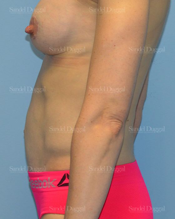 Tummy Tuck after, case 1622