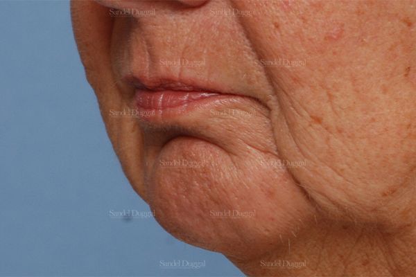 Chin Augmentation before, case 1487