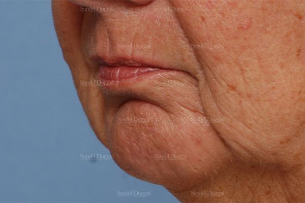Chin Augmentation before, case 1487
