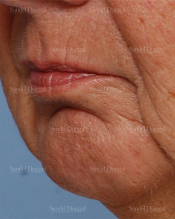 Chin Augmentation before, case 1487