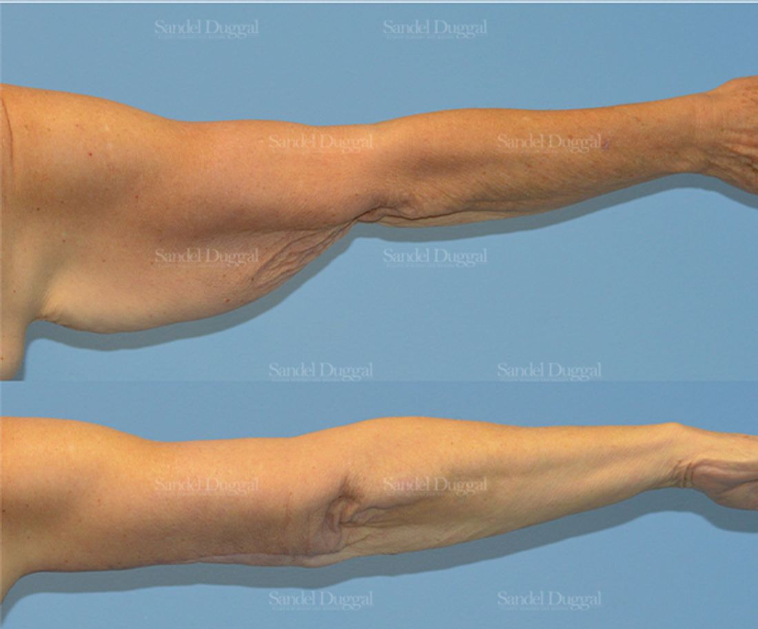 Brachioplasty before and after, case 2150