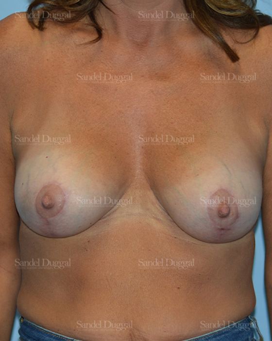 Breast Augmentation with Lift after, case 3407