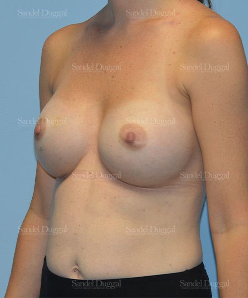Breast Augmentation after, case 3178
