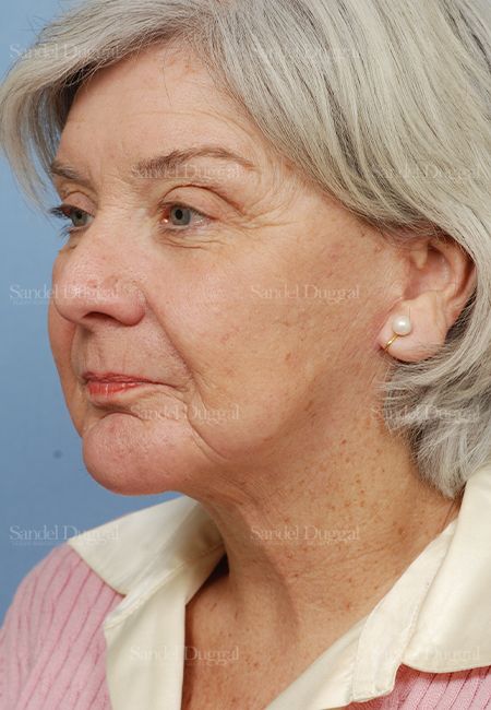 Laser Skin Resurfacing after, case 2950