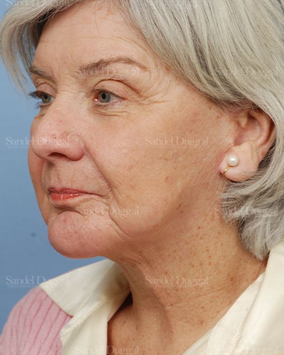 Laser Skin Resurfacing after, case 2950
