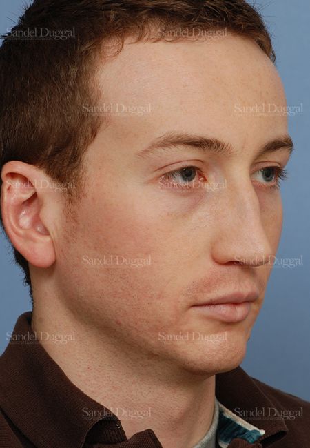 Rhinoplasty before, case 2899