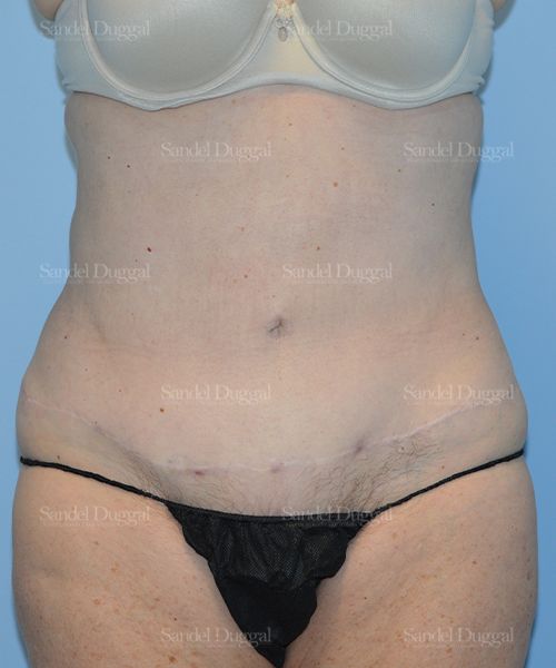 Liposuction — Abdomen after, case 2464