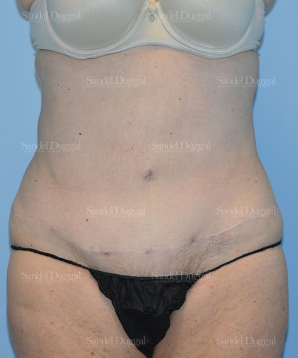 Liposuction — Abdomen after, case 2464