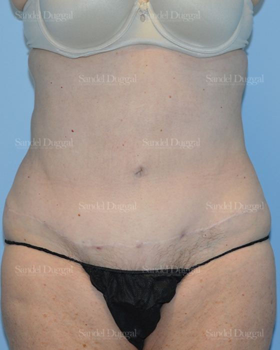 Liposuction — Abdomen after, case 2464