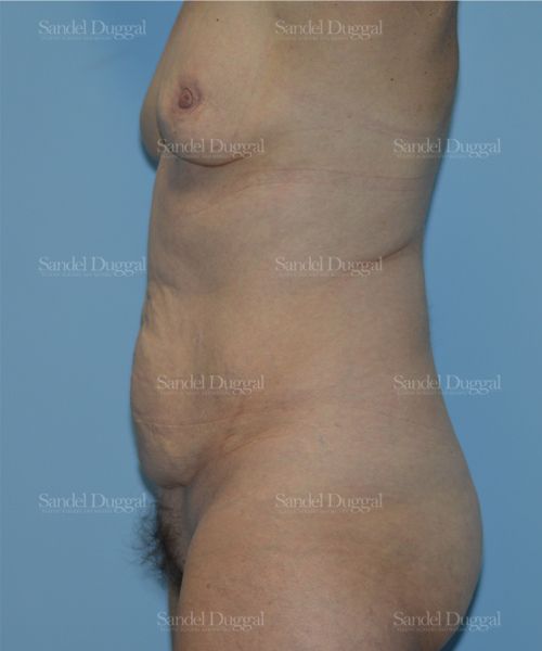 Tummy Tuck before, case 1687