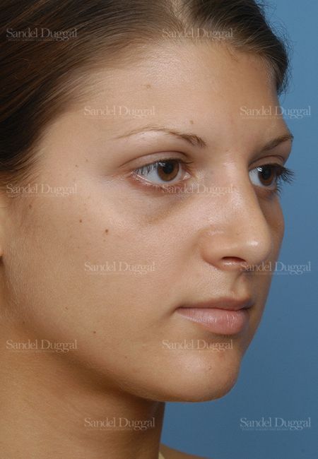 Rhinoplasty after, case 2885