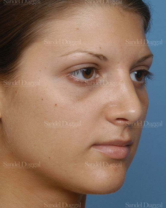 Rhinoplasty after, case 2885