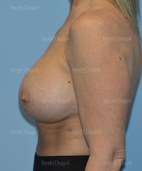 Breast Augmentation with Lift after, case 3386