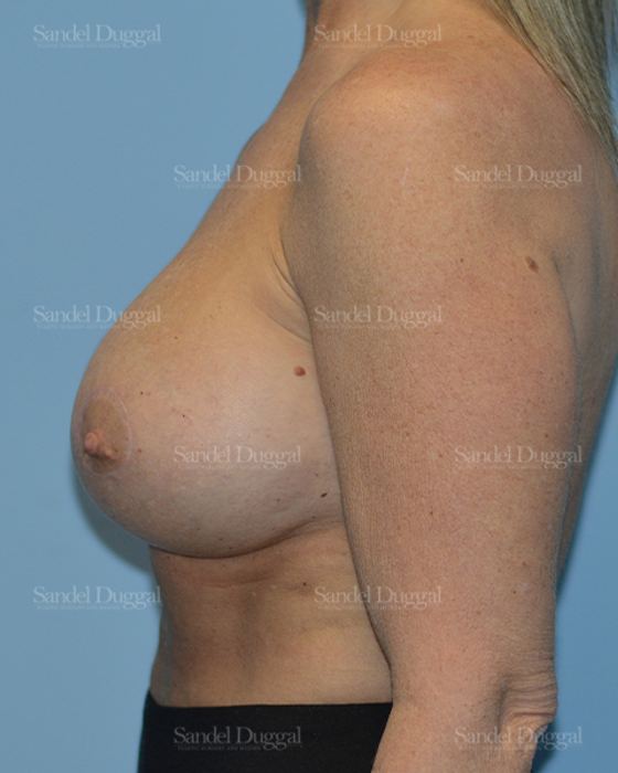 Breast Augmentation with Lift after, case 3386