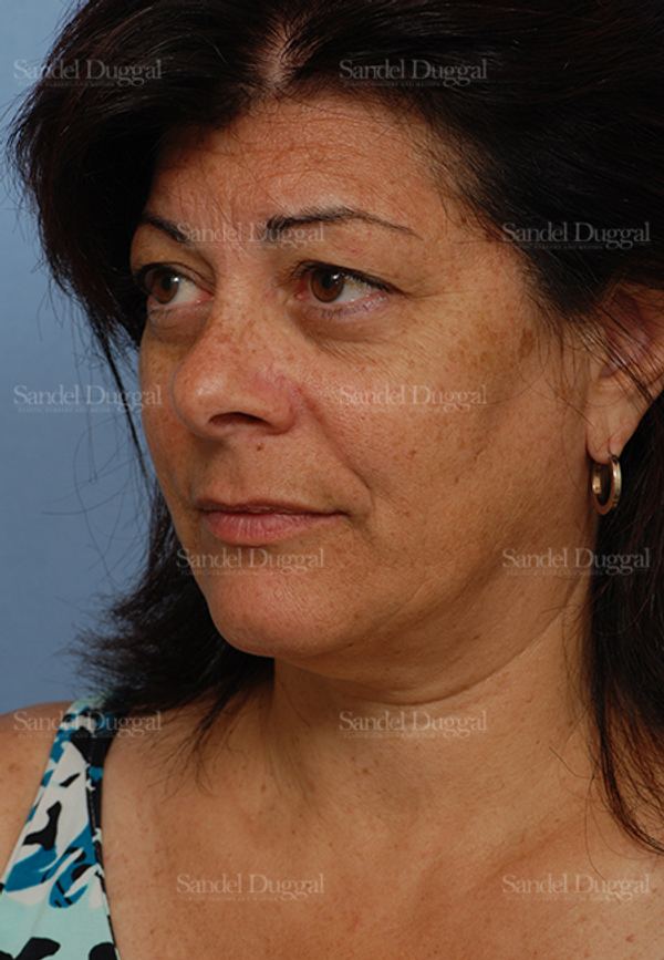 Facelift before, case 2671